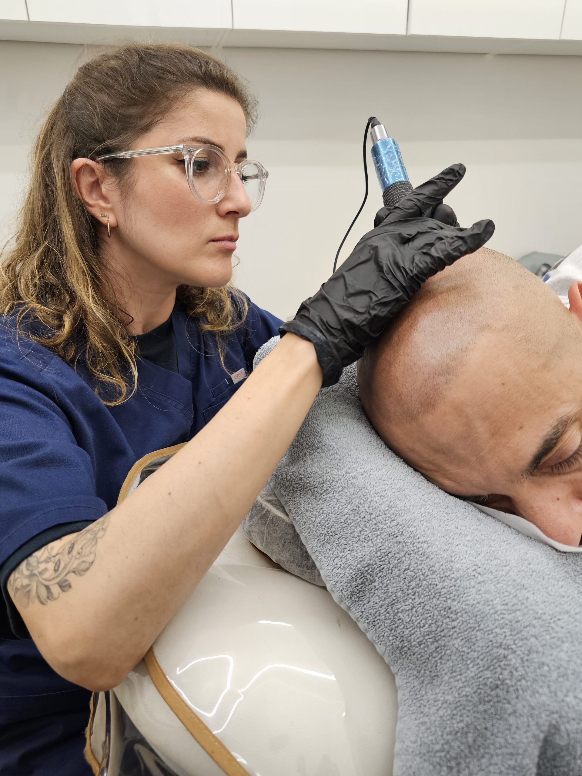 Séance SMP, micropigmentation capillaire, effet crâne rasé, alternative greffe cheveux