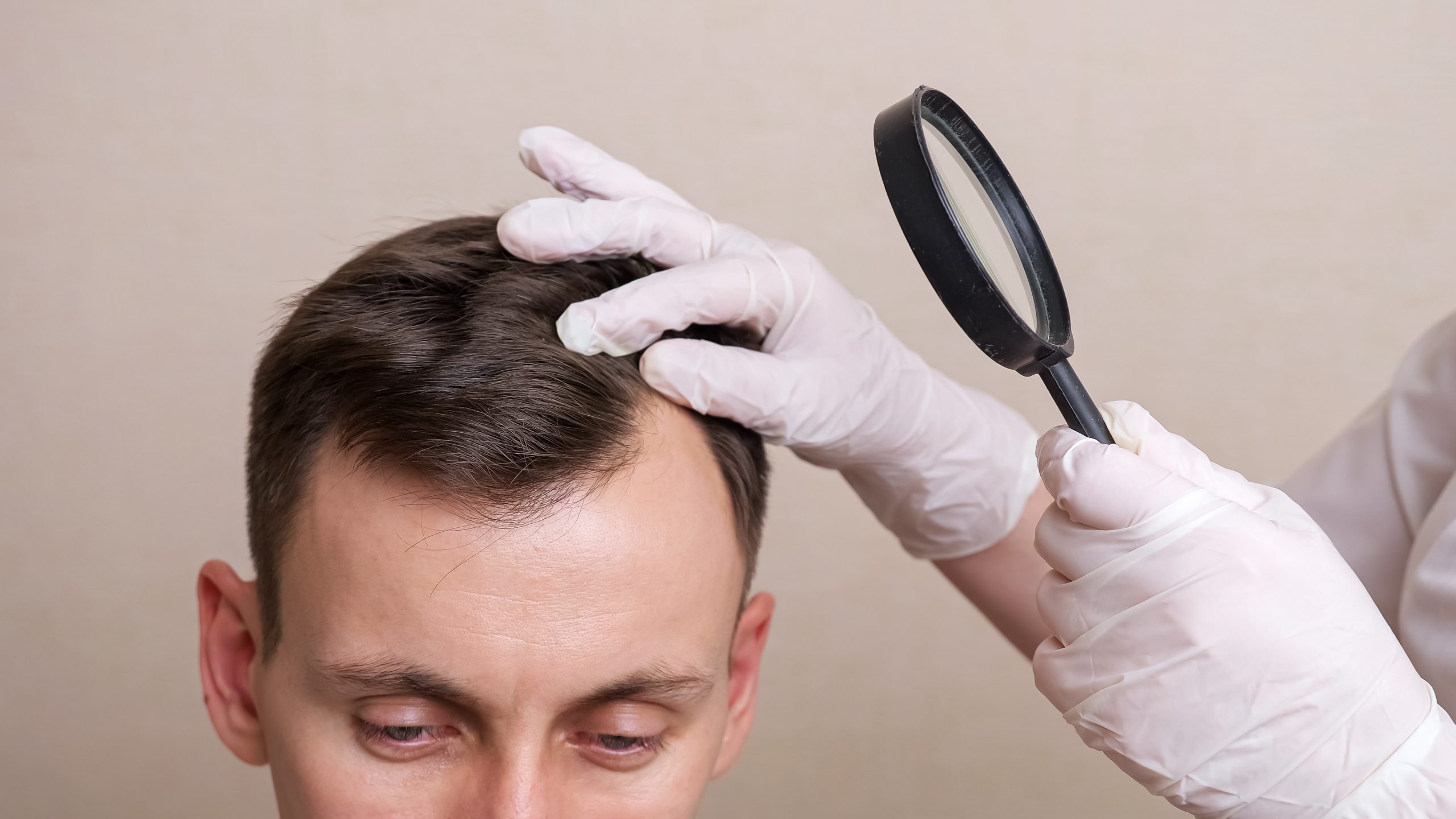 Consultation SMP, consultation gratuite pour solutions à la chute de cheveux, professionnel de la micropigmentation capillaire